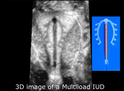 3D Image of a Multiload IUD