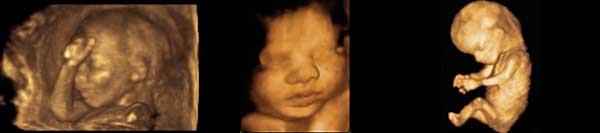 A series three-dimensional ultrasound images