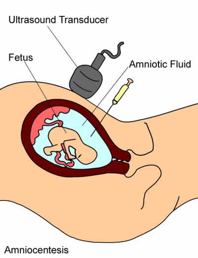 Illustration of the Amniocentesis procedure